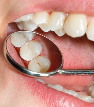 dental sealants in glendale & peoria az