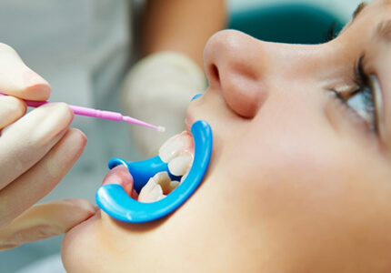 dental sealants for kids in glendale & peoria az
